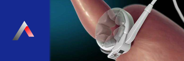 Mide Bantlama (Gastrik Bant)